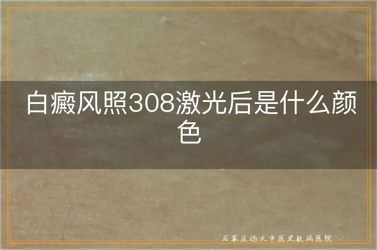 白癜风照308激光后是什么颜色