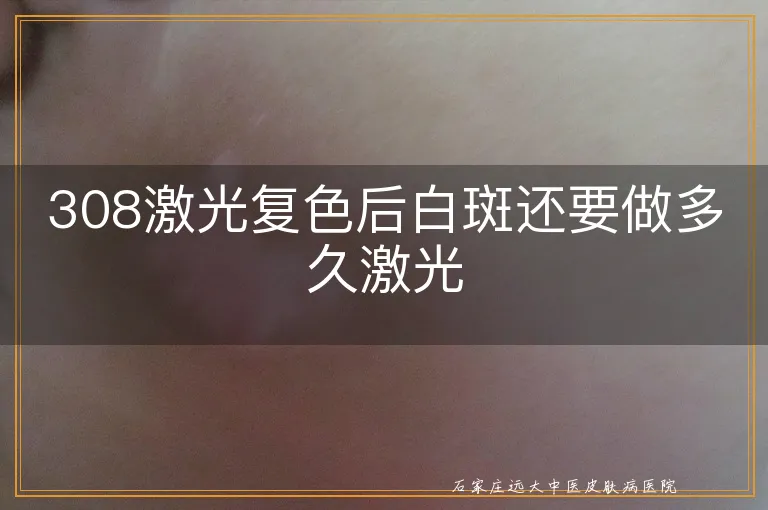 308激光复色后白斑还要做多久激光