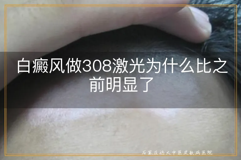 白癜风做308激光为什么比之前明显了