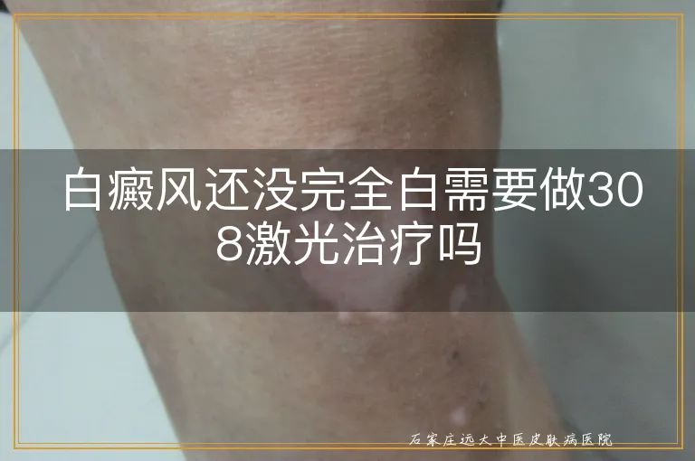 白癜风还没完全白需要做308激光治疗吗