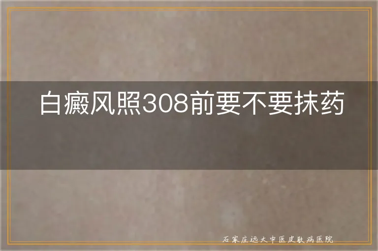 白癜风照308前要不要抹药