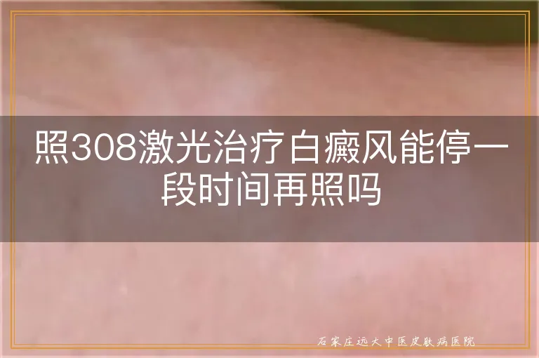 照308激光治疗白癜风能停一段时间再照吗