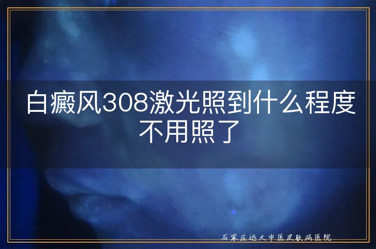 白癜风308激光照到什么程度不用照了