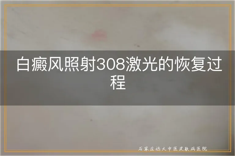 白癜风照射308激光的恢复过程