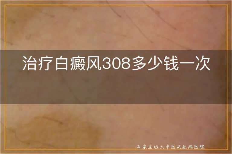 治疗白癜风308多少钱一次