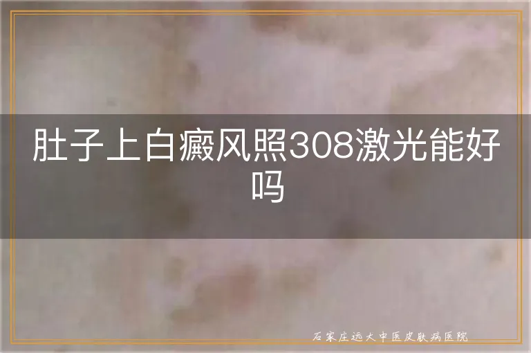 肚子上白癜风照308激光能好吗