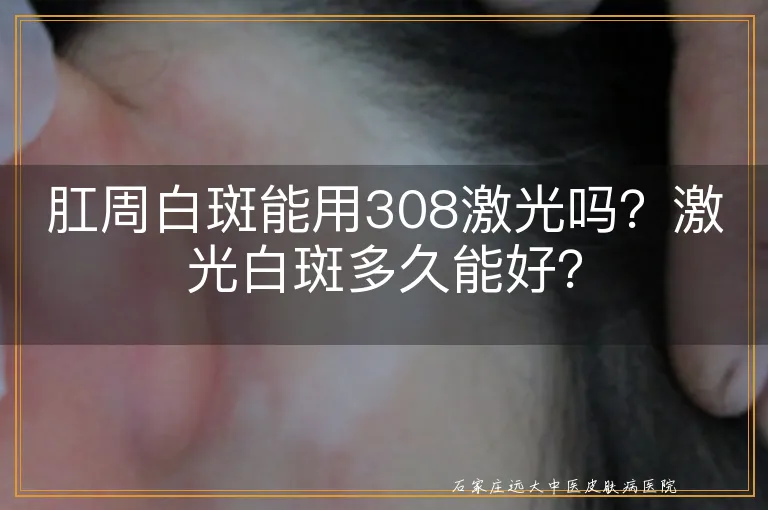 肛周白斑能用308激光吗？激光白斑多久能好？