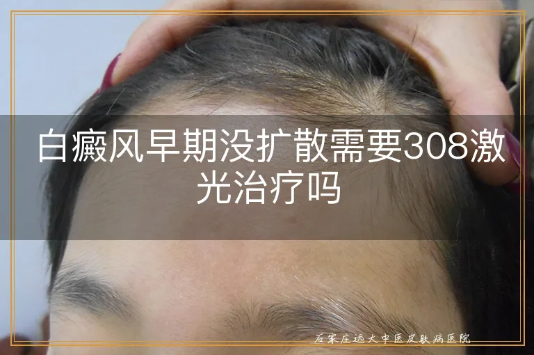 白癜风早期没扩散需要308激光治疗吗