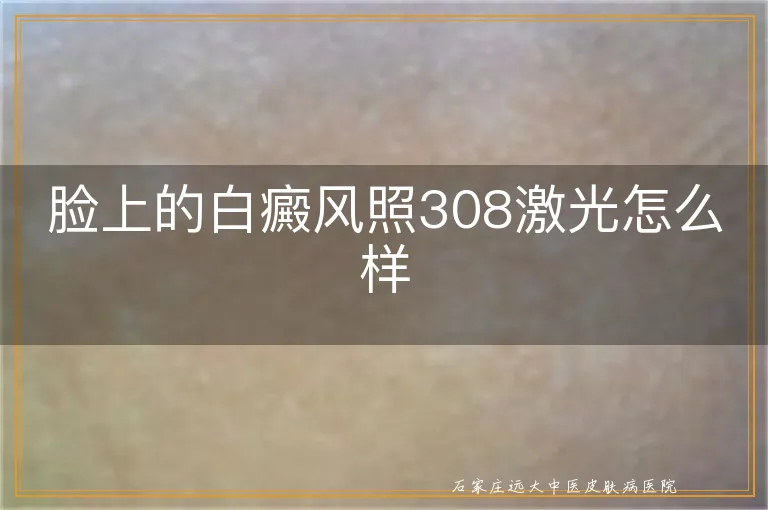 脸上的白癜风照308激光怎么样