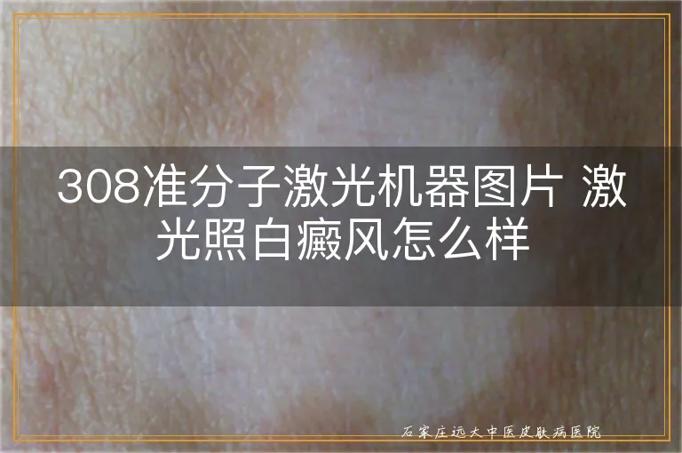 308准分子激光机器图片 激光照白癜风怎么样