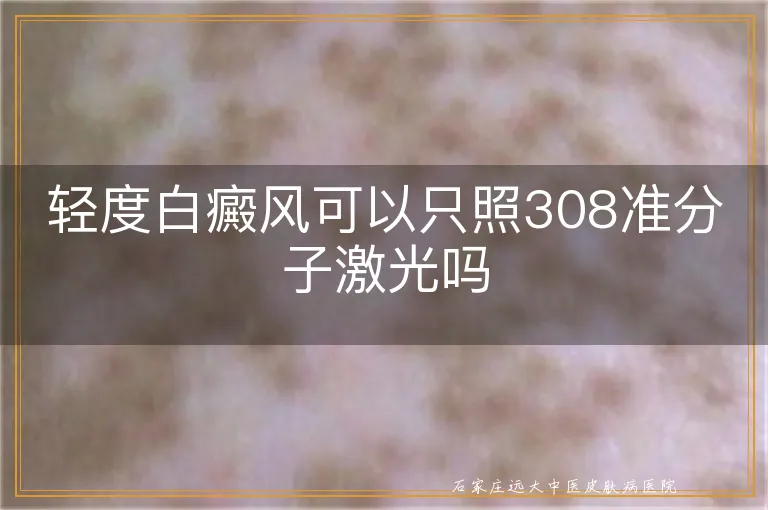 轻度白癜风可以只照308准分子激光吗