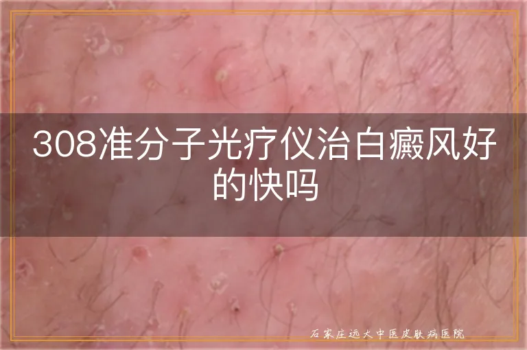 308准分子光疗仪治白癜风好的快吗