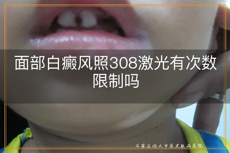 面部白癜风照308激光有次数限制吗