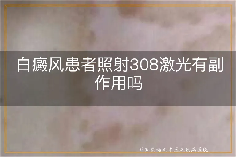 白癜风患者照射308激光有副作用吗