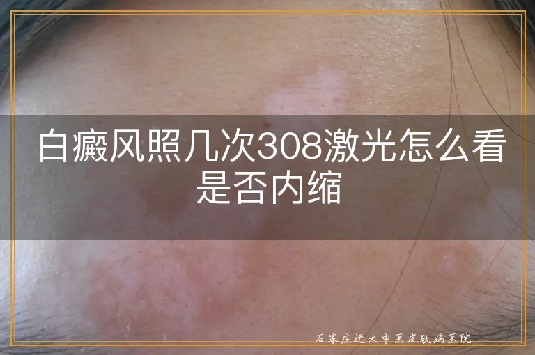 白癜风照几次308激光怎么看是否内缩