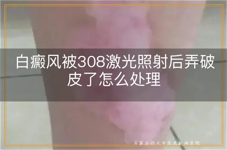 白癜风被308激光照射后弄破皮了怎么处理