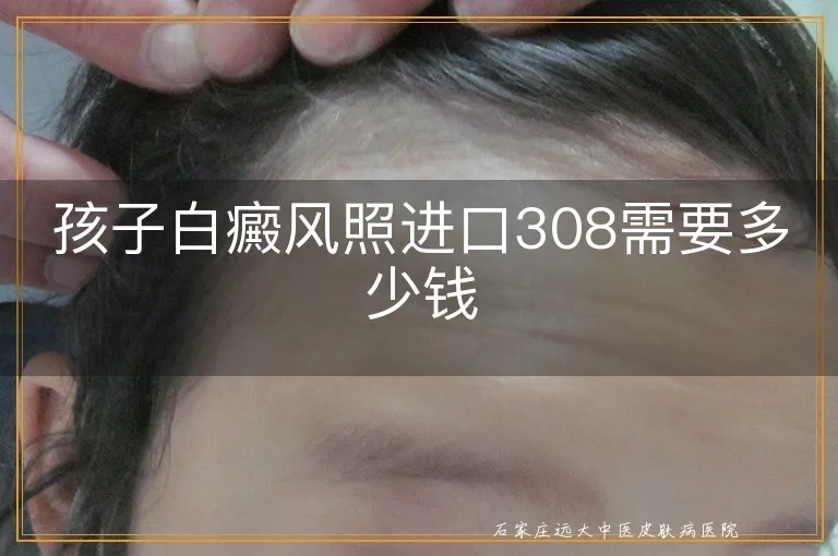 孩子白癜风照进口308需要多少钱