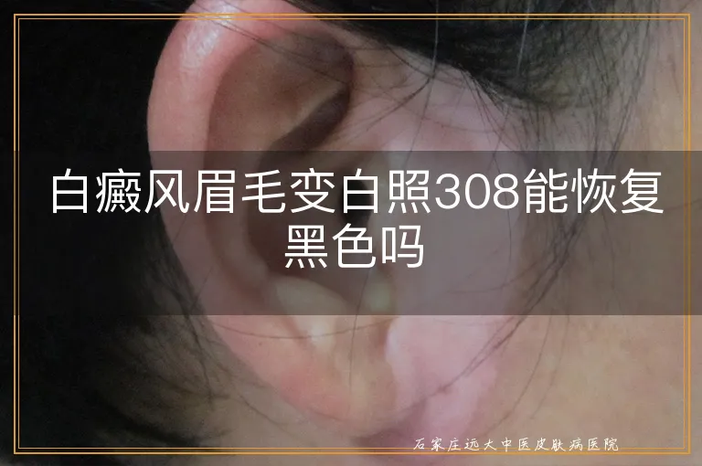 白癜风眉毛变白照308能恢复黑色吗