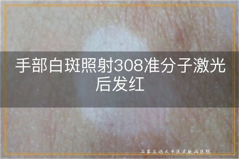 手部白斑照射308准分子激光后发红