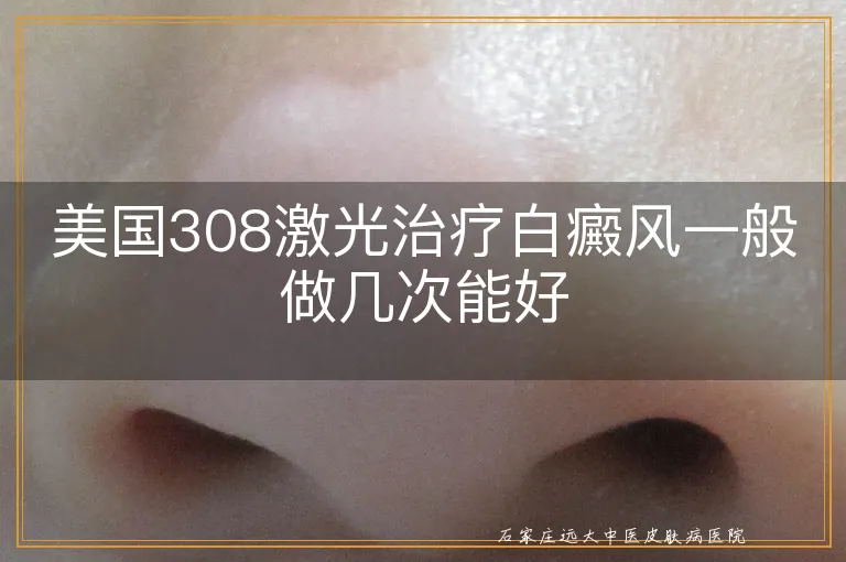 美国308激光治疗白癜风一般做几次能好