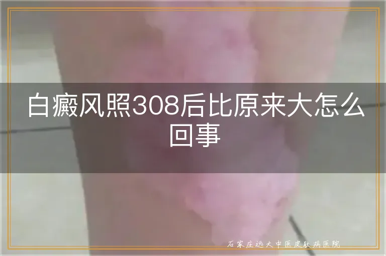 白癜风照308后比原来大怎么回事