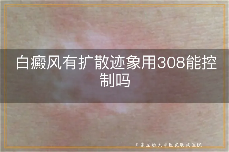 白癜风有扩散迹象用308能控制吗