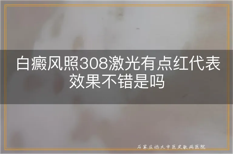 白癜风照308激光有点红代表效果不错是吗