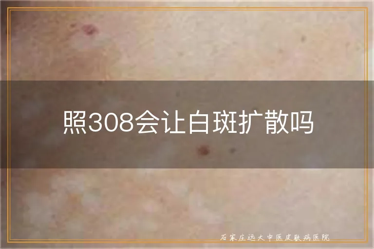 照308会让白斑扩散吗