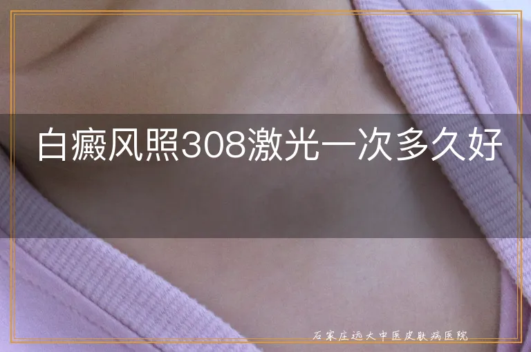 白癜风照308激光一次多久好