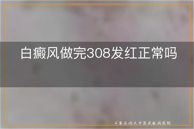 白癜风做完308发红正常吗