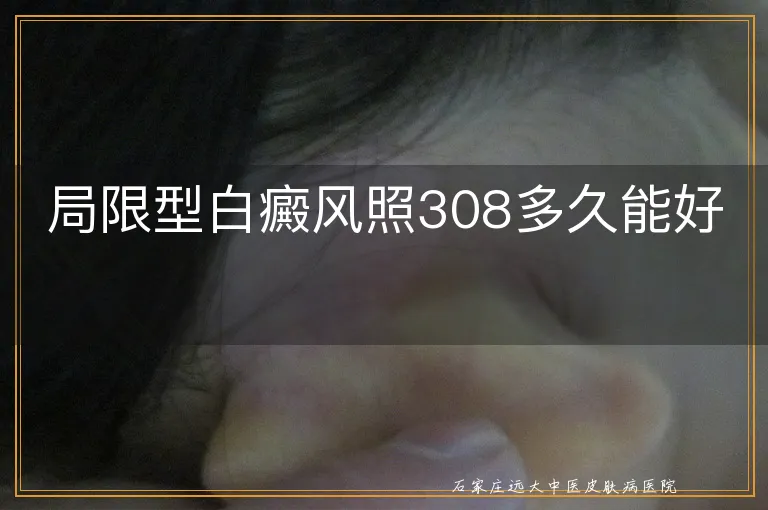 局限型白癜风照308多久能好