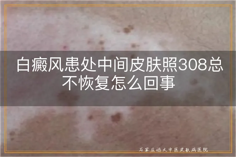 白癜风患处中间皮肤照308总不恢复怎么回事