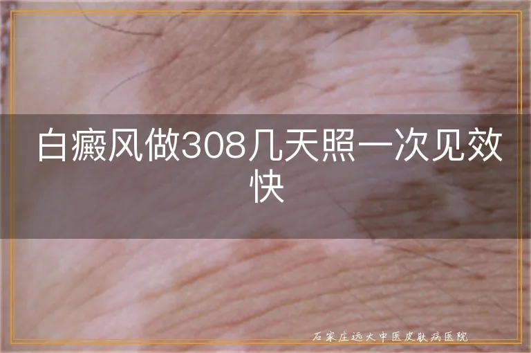 白癜风做308几天照一次见效快