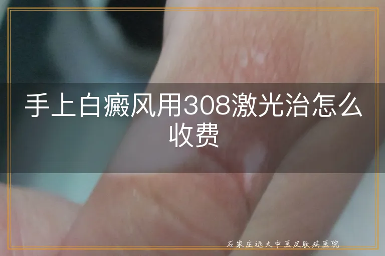 手上白癜风用308激光治怎么收费