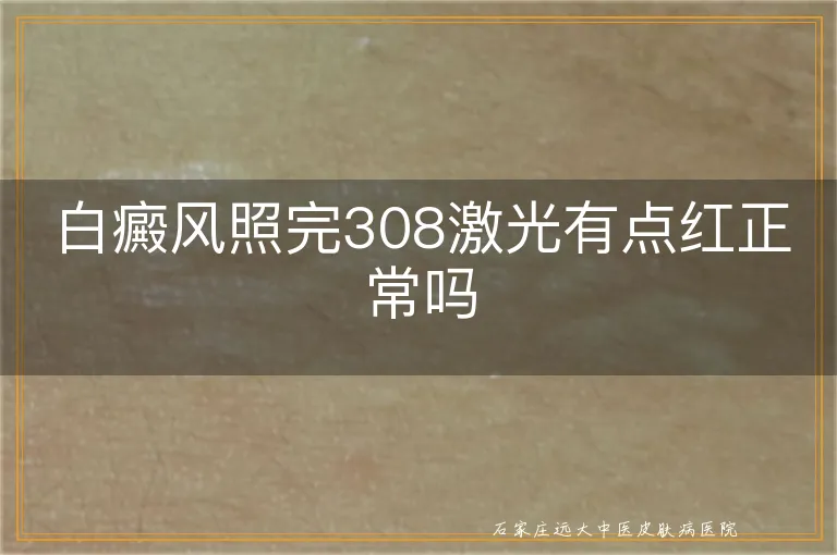 白癜风照完308激光有点红正常吗