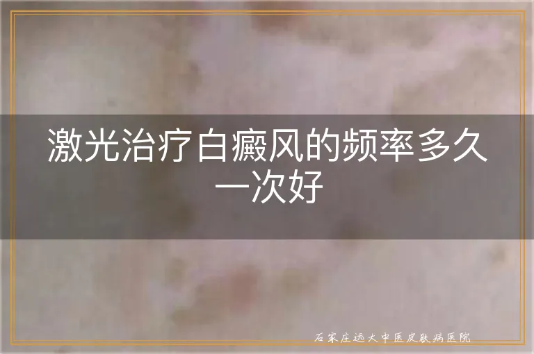 激光治疗白癜风的频率多久一次好