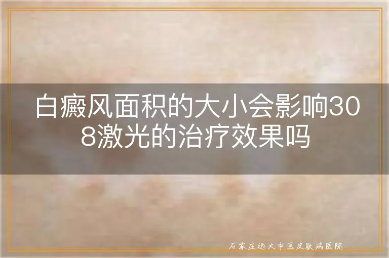 白癜风面积的大小会影响308激光的治疗效果吗