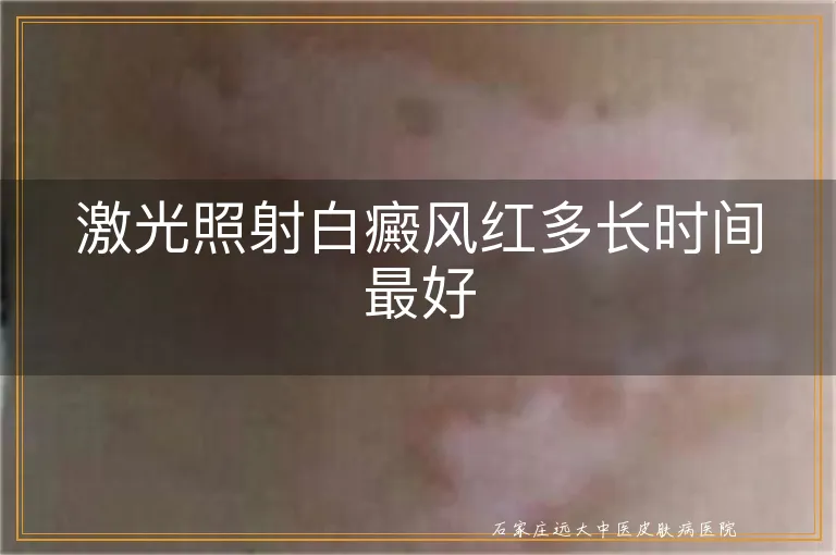 激光照射白癜风红多长时间最好