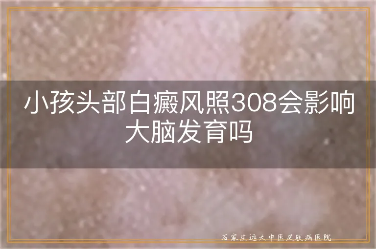 小孩头部白癜风照308会影响大脑发育吗