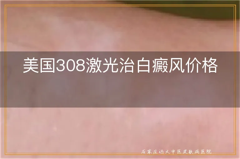 美国308激光治白癜风价格