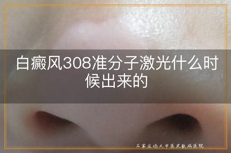 白癜风308准分子激光什么时候出来的