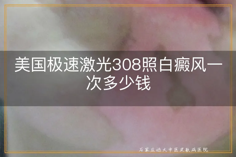 美国极速激光308照白癜风一次多少钱