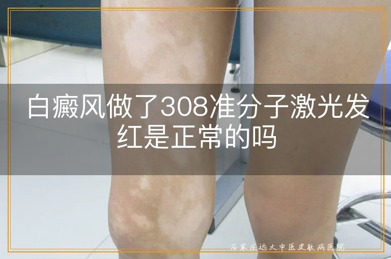 白癜风做了308准分子激光发红是正常的吗