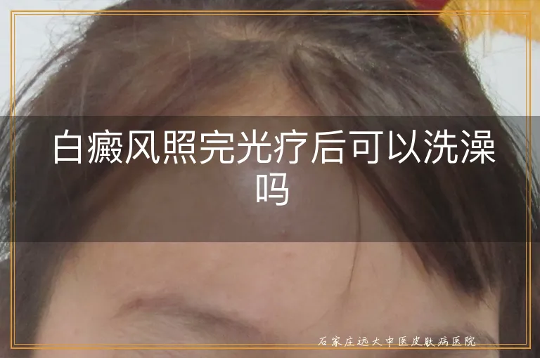 白癜风照完光疗后可以洗澡吗