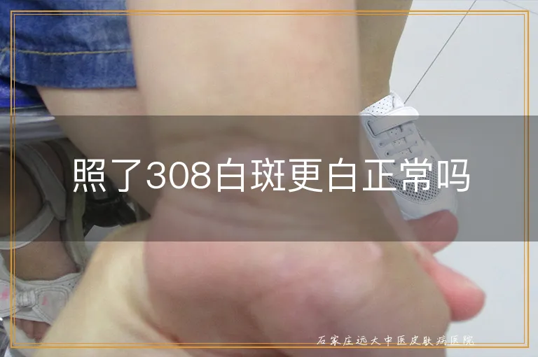 照了308白斑更白正常吗