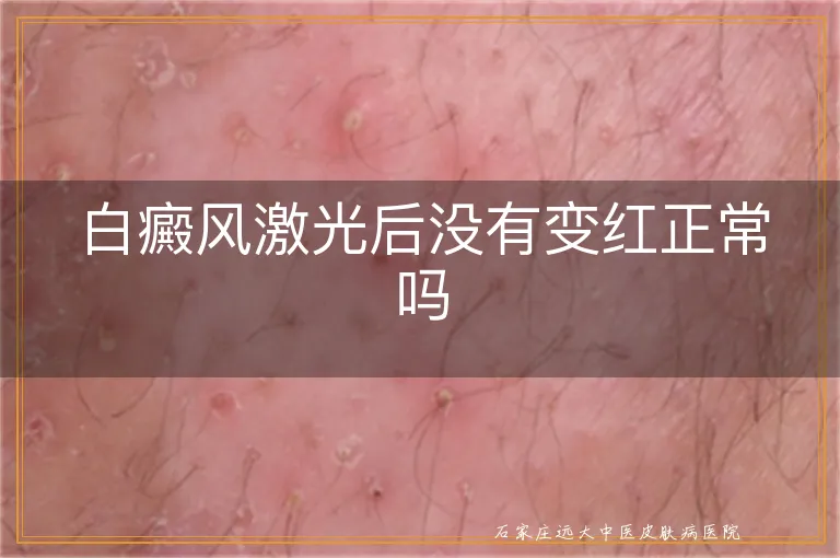 白癜风激光后没有变红正常吗