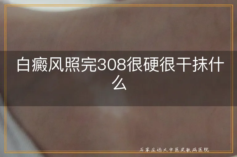 白癜风照完308很硬很干抹什么