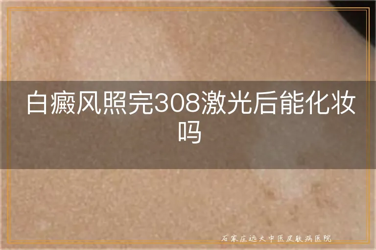 白癜风照完308激光后能化妆吗