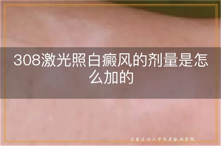 308激光照白癜风的剂量是怎么加的