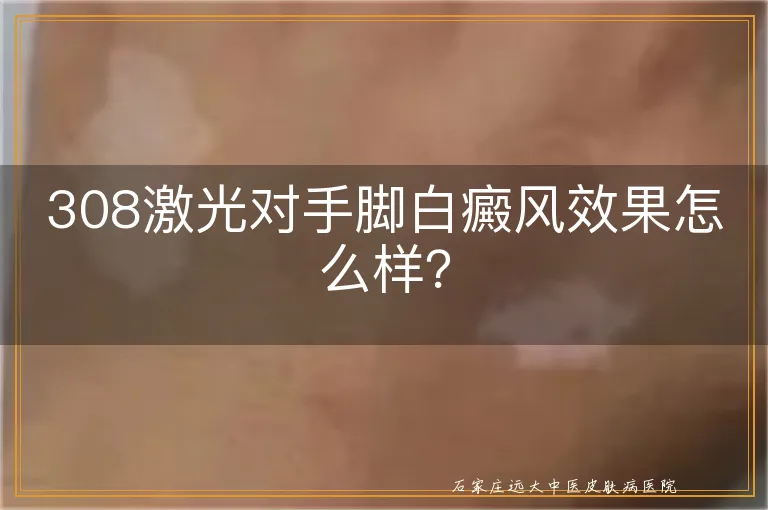 308激光对手脚白癜风效果怎么样？